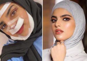 صور سارة الودعاني قبل وبعد عملية التجميل