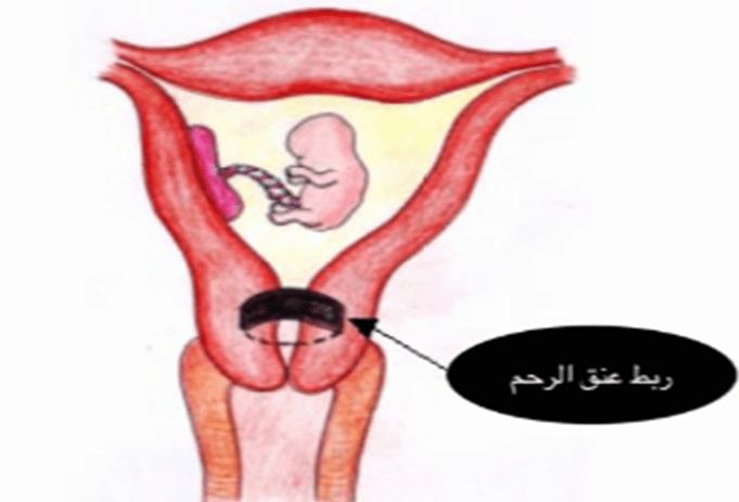 كيف امارس حياتي بعد عملية ربط عنق الرحم